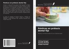 Couverture de Pónticos en prótesis dental fija