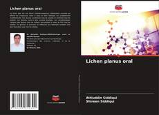 Couverture de Lichen planus oral