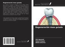 Bookcover of Regeneración ósea guiada