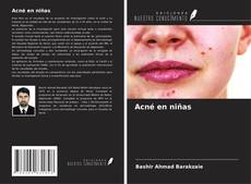 Bookcover of Acné en niñas