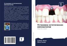 Bookcover of Установка эстетических имплантатов