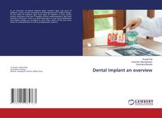 Copertina di Dental Implant an overview
