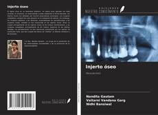 Bookcover of Injerto óseo