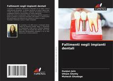 Обложка Fallimenti negli impianti dentali