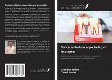 Sobredentadura soportada por implantes的封面