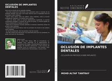 Buchcover von OCLUSIÓN DE IMPLANTES DENTALES