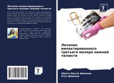 Bookcover of Лечение импактированного третьего моляра нижней челюсти