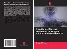 Bookcover of Invasão de Bony no carcinoma de células escamosas mandibulares