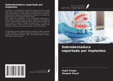 Borítókép a  Sobredentadura soportada por implantes - hoz