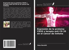 Buchcover von Expresión de la proteína CD20 y terapia anti CD 20 en el cáncer de linfoma