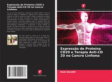 Expressão de Proteína CD20 e Terapia Anti-CD 20 no Cancro Linfoma的封面