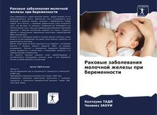 Buchcover von Раковые заболевания молочной железы при беременности