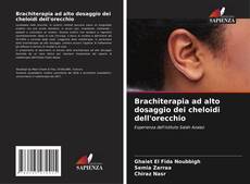 Bookcover of Brachiterapia ad alto dosaggio dei cheloidi dell'orecchio