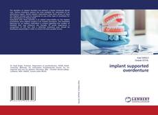 Copertina di implant supported overdenture