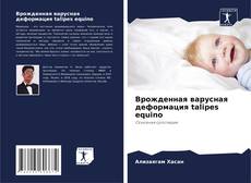Bookcover of Врожденная варусная деформация talipes equino