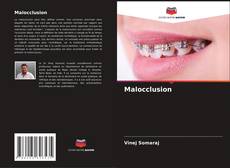 Bookcover of Malocclusion