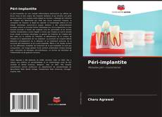 Bookcover of Péri-implantite