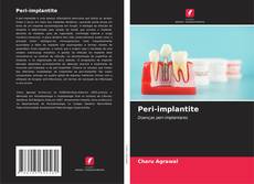 Capa do livro de Peri-implantite 