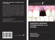 Bookcover of Implantes dentales: Complicaciones y su manejo