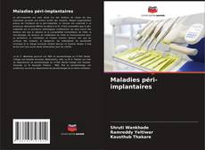Bookcover of Maladies péri-implantaires