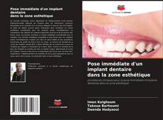 Copertina di Pose immédiate d'un implant dentaire dans la zone esthétique