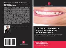 Colocação imediata de implantes dentários na zona estética的封面