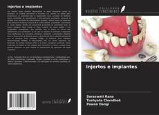 Capa do livro de Injertos e implantes 