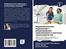 Bookcover of Периапикальное поражение с ретроградным заполнением и костным трансплантатом