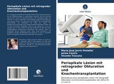 Buchcover von Periapikale Läsion mit retrograder Obturation und Knochentransplantation