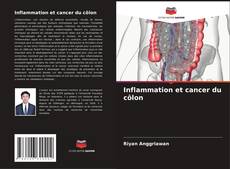 Inflammation et cancer du côlon kitap kapağı