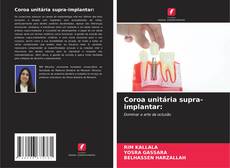 Coroa unitária supra-implantar:的封面