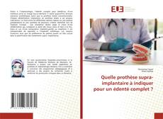 Couverture de Quelle prothèse supra-implantaire à indiquer pour un édenté complet ?