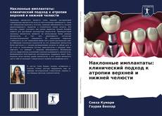 Bookcover of Наклонные имплантаты: клинический подход к атропии верхней и нижней челюсти