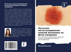 Buchcover von Легочное метастазирование кожной меланомы на фоне ожирения