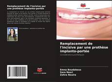 Buchcover von Remplacement de l'incisive par une prothèse implanto-portée