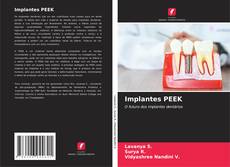 Bookcover of Implantes PEEK