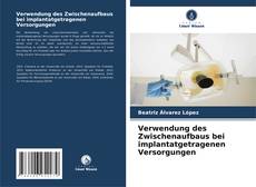Borítókép a  Verwendung des Zwischenaufbaus bei implantatgetragenen Versorgungen - hoz