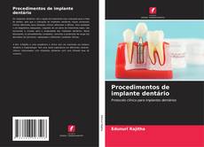 Bookcover of Procedimentos de implante dentário