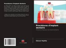Bookcover of Procédures d'implant dentaire