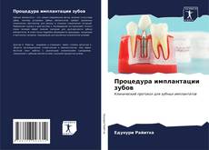 Bookcover of Процедура имплантации зубов