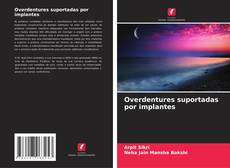 Buchcover von Overdentures suportadas por implantes
