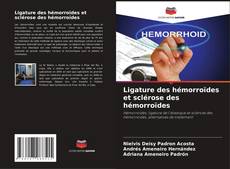 Buchcover von Ligature des hémorroïdes et sclérose des hémorroïdes