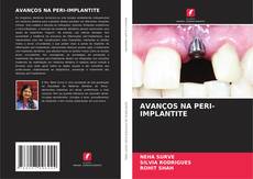 Обложка AVANÇOS NA PERI-IMPLANTITE