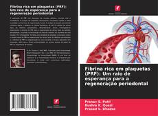 Capa do livro de Fibrina rica em plaquetas (PRF): Um raio de esperança para a regeneração periodontal 