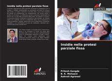 Bookcover of Insidie nella protesi parziale fissa