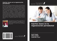 Buchcover von Injertos óseos en la regeneración periodontal