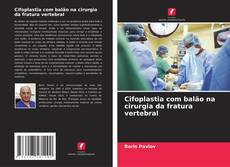 Borítókép a  Cifoplastia com balão na cirurgia da fratura vertebral - hoz