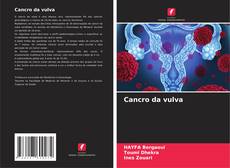 Capa do livro de Cancro da vulva 