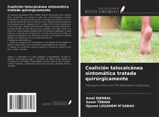 Bookcover of Coalición talocalcánea sintomática tratada quirúrgicamente