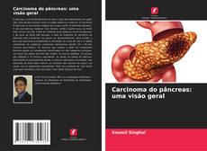 Обложка Carcinoma do pâncreas: uma visão geral